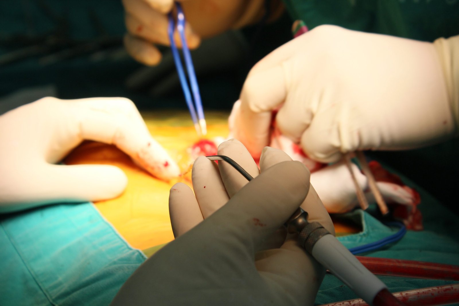 Leucodepletion Facility